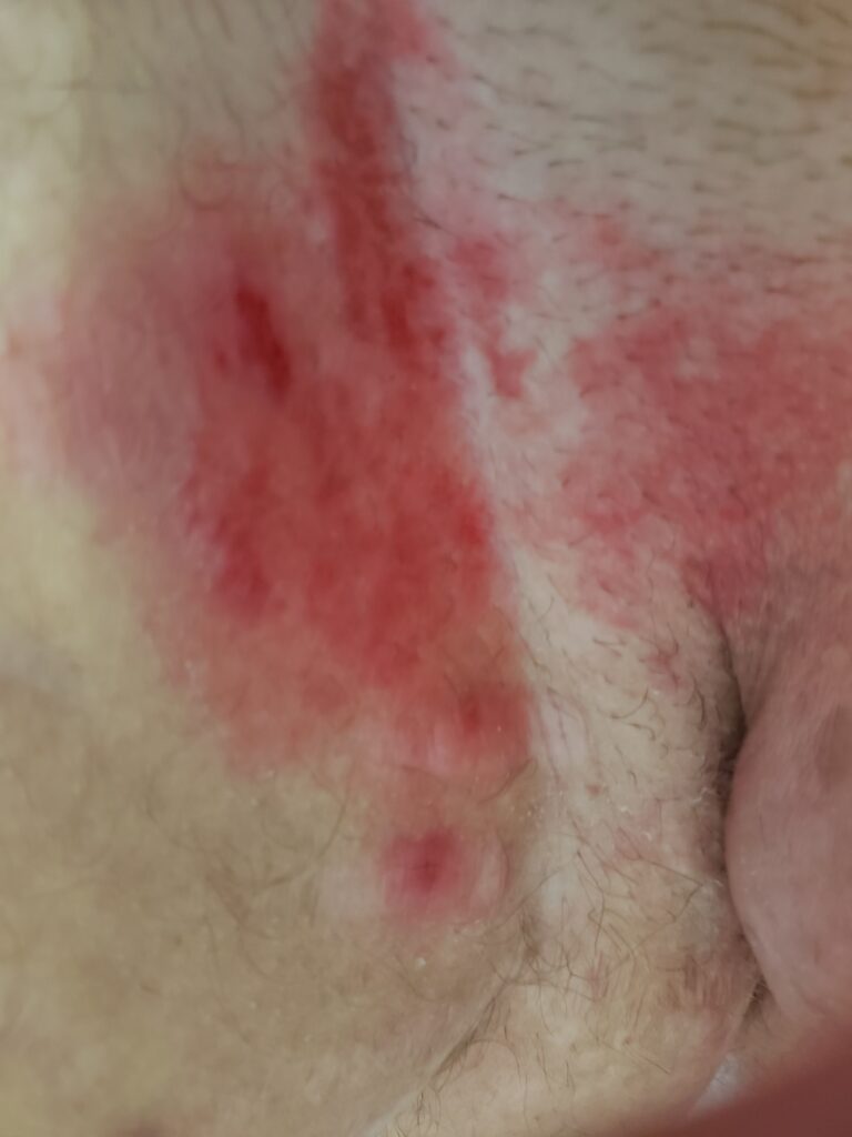 Para que serve esquentar o Prestobarba no fogo? Para que serve esquentar o Prestobarba no fogo?